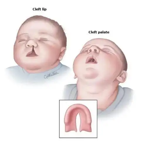兔唇宝宝我和所有人都不一样但和所有人都一样
