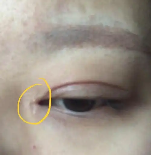 割完双眼皮两个月后长出了两个白色点点是增生吗?