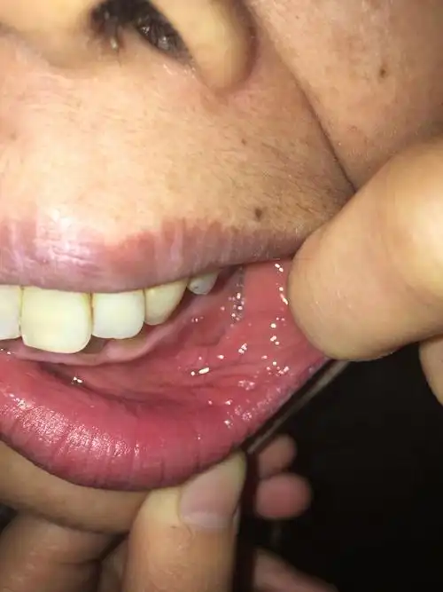 嘴唇内壁长了一圈肉疙瘩聚结在一起,不疼但是紧的难受很长时间了是