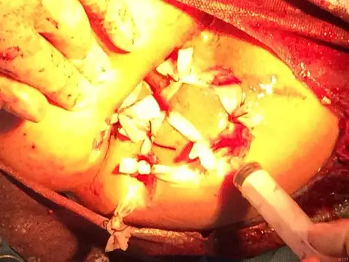 巨大环状混合痔