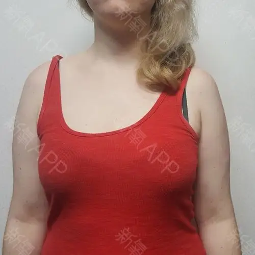 我有一颗a罩杯足够大的胸,但我一直希望有更丰满,更_圈子-新氧美容