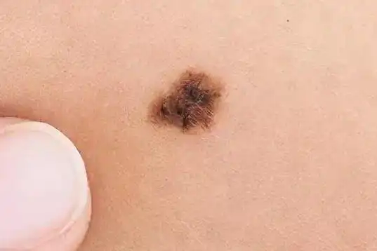 黑色以及蓝色为主,体积一般在5毫米以下,有可能是扁平状,凸起状存在