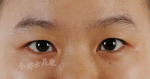 各种内眦赘皮的处理对策(即如何选择适当的开眼角方法) - 好大夫在线