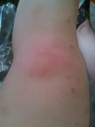 晚上全身发热,全身都痒,这个部位最痒,第二天就肿了而且痛,这是什么来