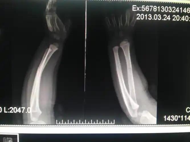 左尺桡骨折青枝骨折