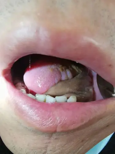 舌癌前臂皮瓣修复(病例分享)