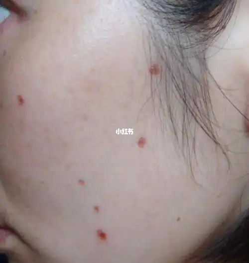 点痣第15天终于掉痂了