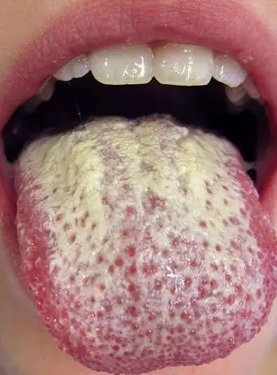 1分钟舌头自我检测!如果有「这些状况」最好去找医生检查!