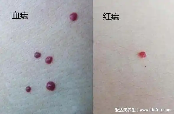 皮肤上有小红点像血点图片及原因,可能是紫癜(正常红点图片)