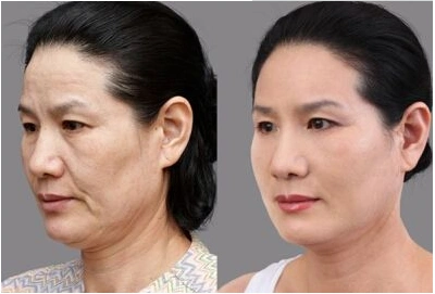 肉毒素除皱的效果好不好,要看这几点!