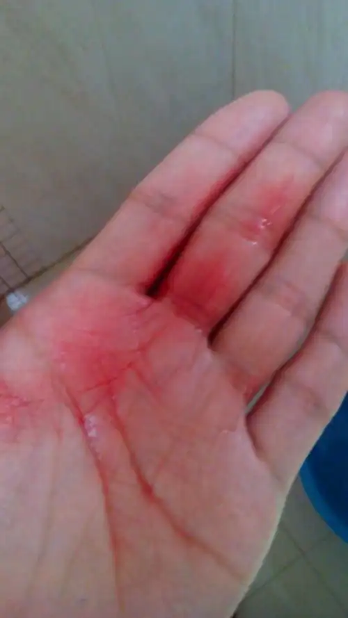 嗓子疼,咳嗽咳出血了是怎么回事?