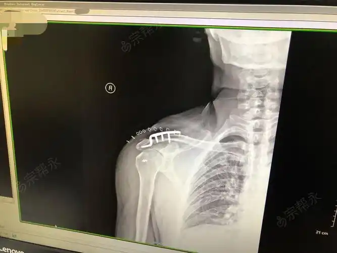 右肩锁关节脱位切开复位内固定术