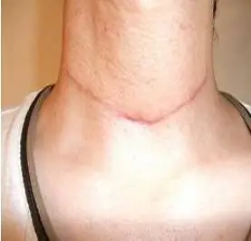 甲状腺瘤的病因与症状表现