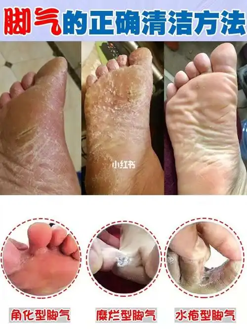 治疗脚气强力cp,完美根治!