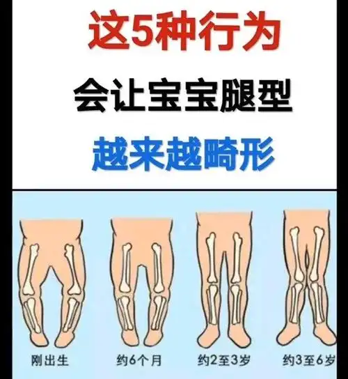 5种行为会让宝宝腿型越来越畸形 1岁以内:婴幼儿腿部会呈椭圆状
