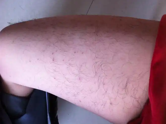 大腿上这样是毛囊炎吗我每天都穿牛仔裤裤子经常摩擦到大腿