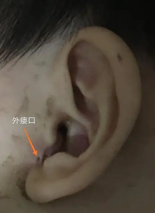 秦昊医生手记～20190306第一鳃裂瘘管切除 面神经解剖术 - 好大夫在线