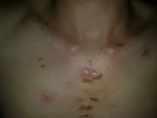 胸口中间长了些硬结突起,不知道是什么病.有时发炎的时候有疼痛.