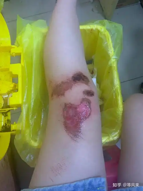 开一个膝盖腿伤恢复记录帖