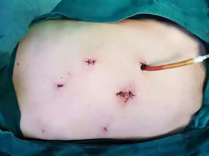 医疗技术普外中心腔镜技术新高度完全腹腔镜下巨脾切除术