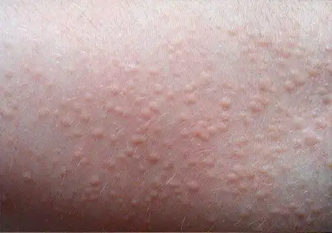 皮肤病图片对照大全查看图片常见种类及症状识别_银屑病求医网