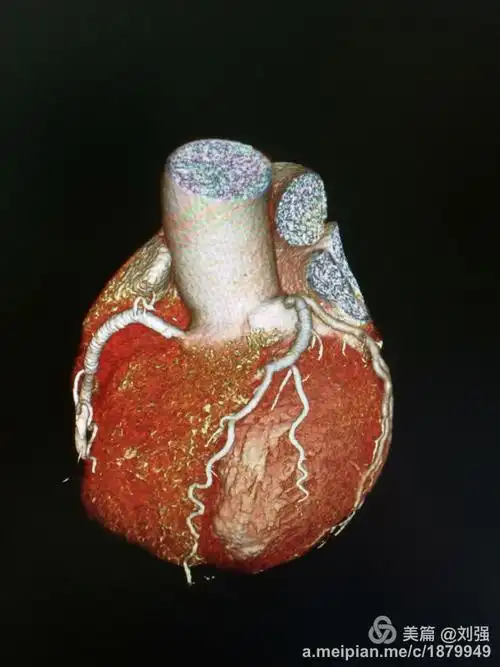 心脏冠状动脉造影