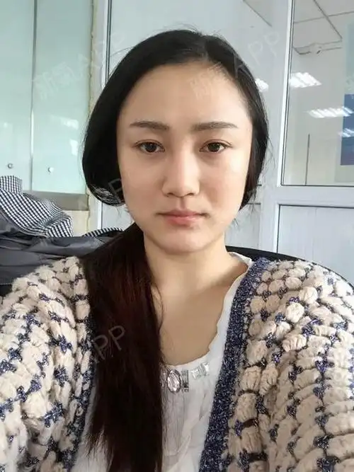 【杭州珈禾-瘦脸针-第18天】