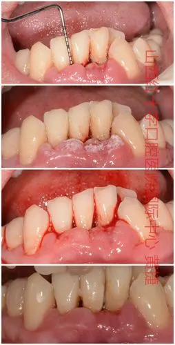 牙周脓肿病例展示