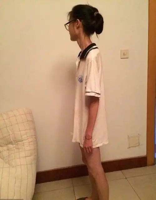 90后女孩跟风节食减肥失控瘦成晾衣杆为增肥花费40万