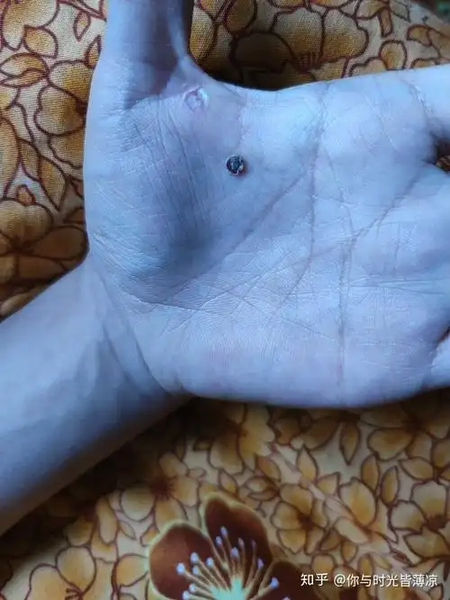 液氮冷冻治疗后手指上出了血泡而且越来越大该怎么办