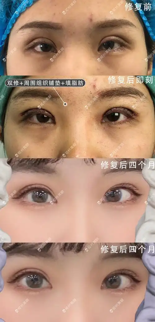 双眼皮修复田氏切开修复效果图