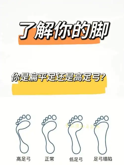 你是扁平足还是高足弓——了解你的脚