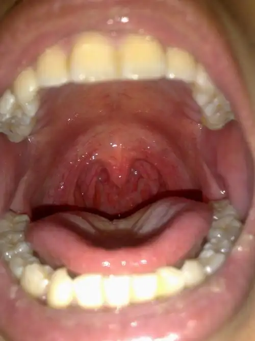 大哥 帮忙看看喉咙吧 急性化脓性扁桃腺炎