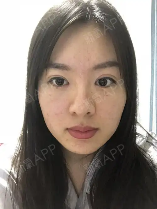 拆线后才3天,就迫不及待的来跟各位爱美的小姐姐分享术后的样子.