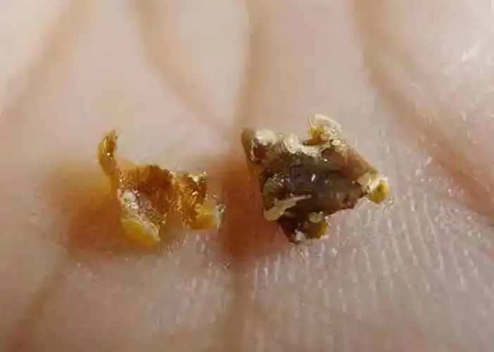 为啥有人"耳屎"是湿的,有的却是干的?或和这件"尴尬事"有关