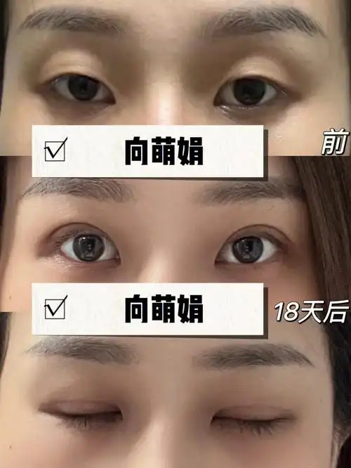 双眼皮脂肪转移提肌