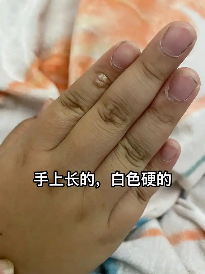 小孩手上长的,白色硬的,越长越大,有知道这是什么的吗?#皮肤 - 抖音