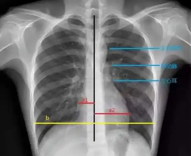 梨形心,靴形心,烧瓶心 :这也样看平片,想不会都难