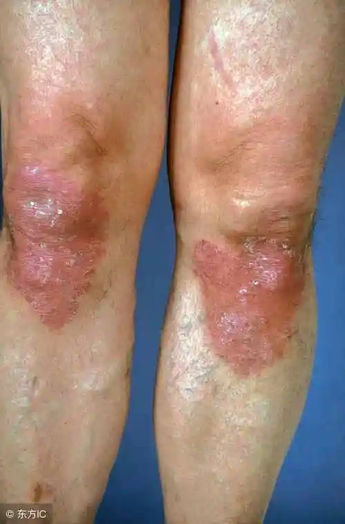 普通皮癣图片寻常型牛皮癣