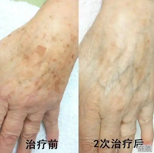 光子去痘价格_光子美白嫩肤原理_光子嫩肤能去痘吗