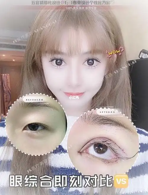 眼综合即刻对比78大眼女神的必选项目[爱心]术后眼睛明亮有神弧度