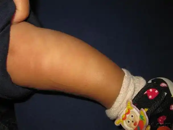 为什么小孩脸上长白斑呢 - 冷求网