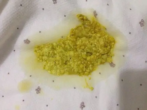 基本只要一吃奶就拉,刚拉的大便突然不正常,求专家帮忙看看_百度宝宝