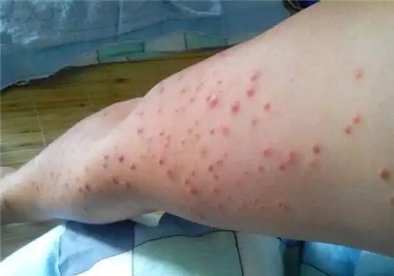 艾滋病初期症状皮疹多久会消失