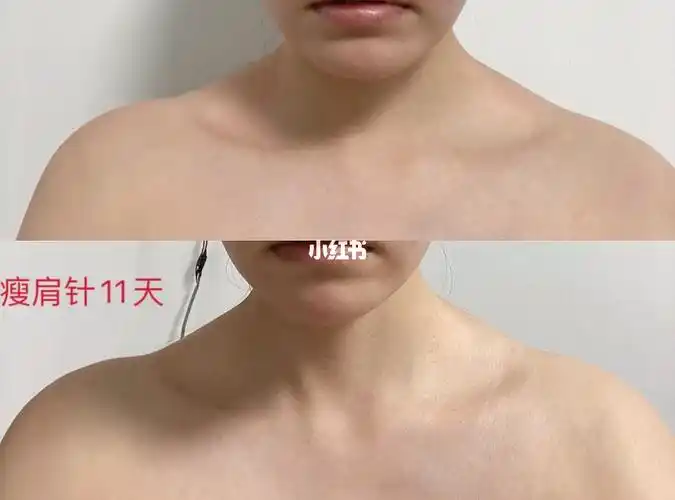 瘦肩针11天_瘦肩_斜方肌_瘦肩针_减肥_减肥医药