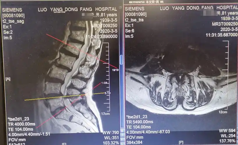 大通道脊柱内镜下经椎板间隙单侧入路双侧减压技术治疗腰椎管狭窄症