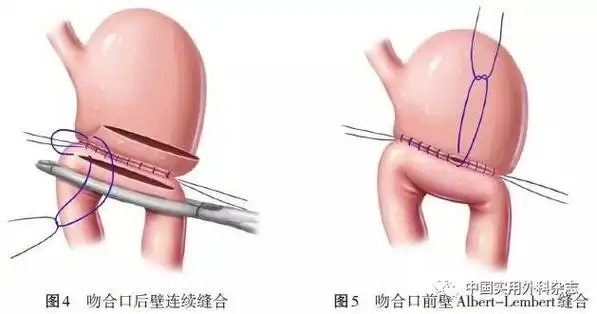 胃肠外科手术缝合技术与缝合材料选择中国专家共识2018版附名家手术