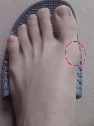 右脚大拇指有点外翻,关节处有点酸疼,是什么原因,需要治疗吗