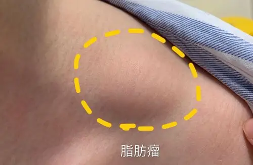 脂肪瘤_脂肪瘤_介绍_症状表现 - 好大夫在线
