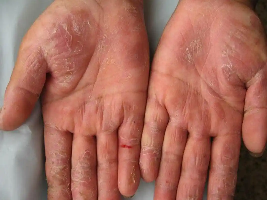 双手粗糙,脱皮,还有裂口,又痒又痛 ?这个就是手部慢性湿疹!